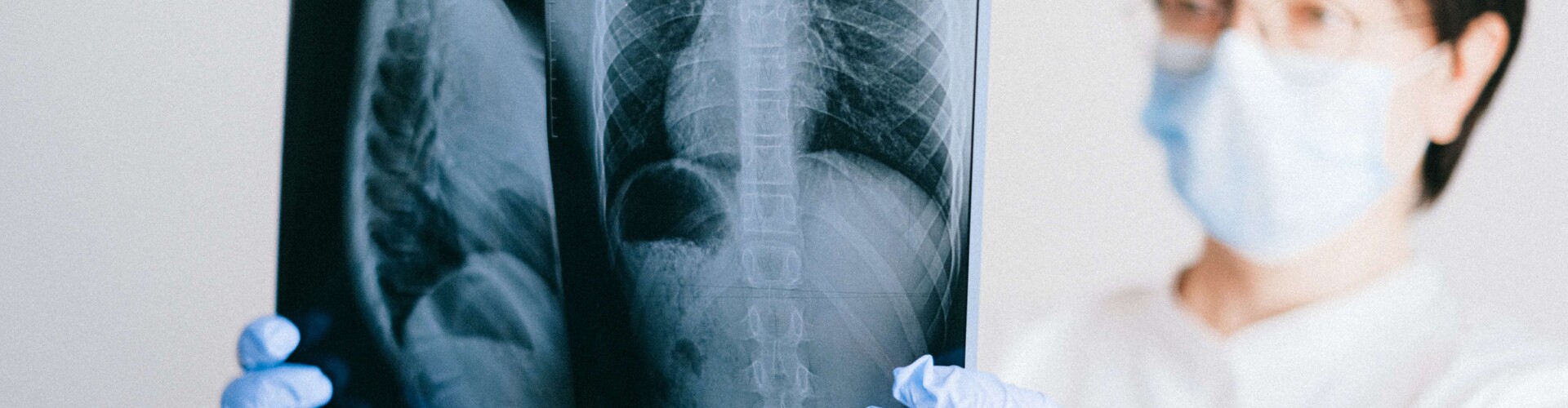 Longembolie, afsluiting van een longslagader, pulmonary embolism, blockage of a pulmonary artery, pulmonary blood vessel obstruction