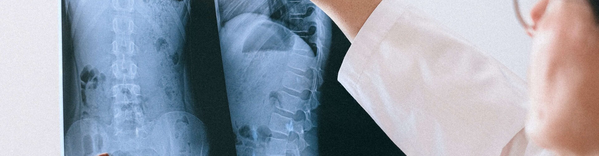 Pancoasttumor, longtoptumor, pancoastsyndroom, superior sulcus syndrome, superior sulcus tumor