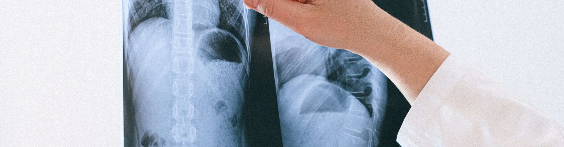 COPD (chronic obstructive pulmonary disease), chronische obstructieve longziekte, chronische bronchitis, longemfyseem, chronic bronchitis, emphysema