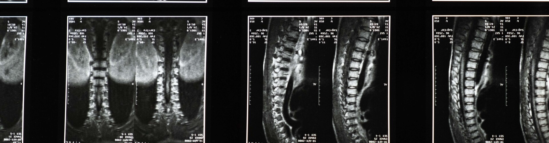 Ziekte van Bechterew, axiale spondylartritis, spondylitis ankylopoetica, ankyloserende spondylitis, ankylosing spondylitis, bamboo spine