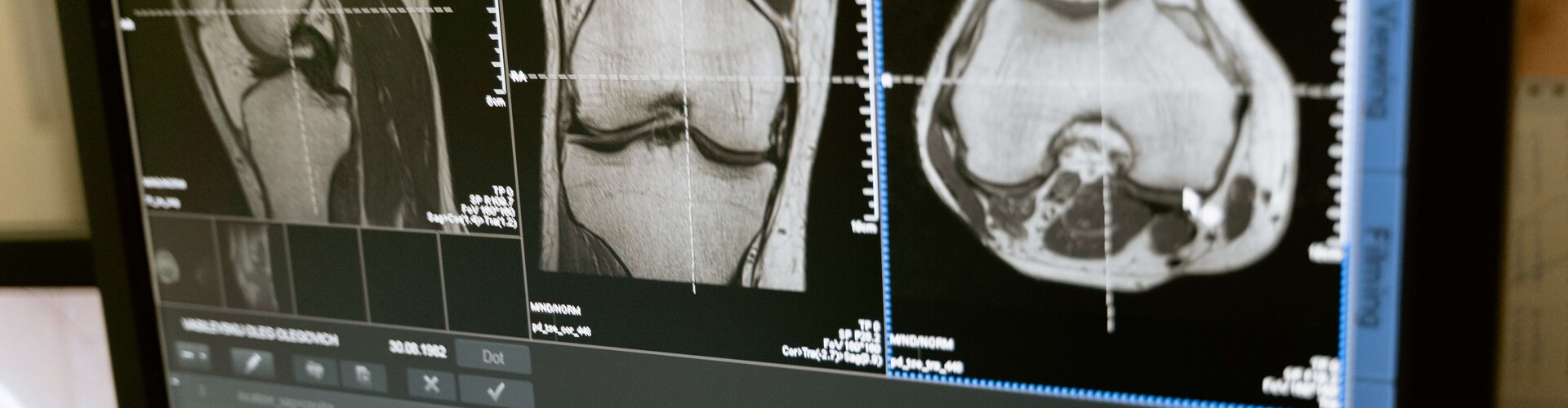 Botkneuzing, bone bruise, periosteal hematoma
