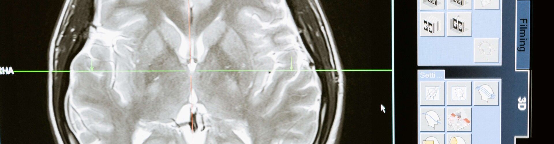  Epilepsie, vallende ziekte, epilepsy, falling sickness