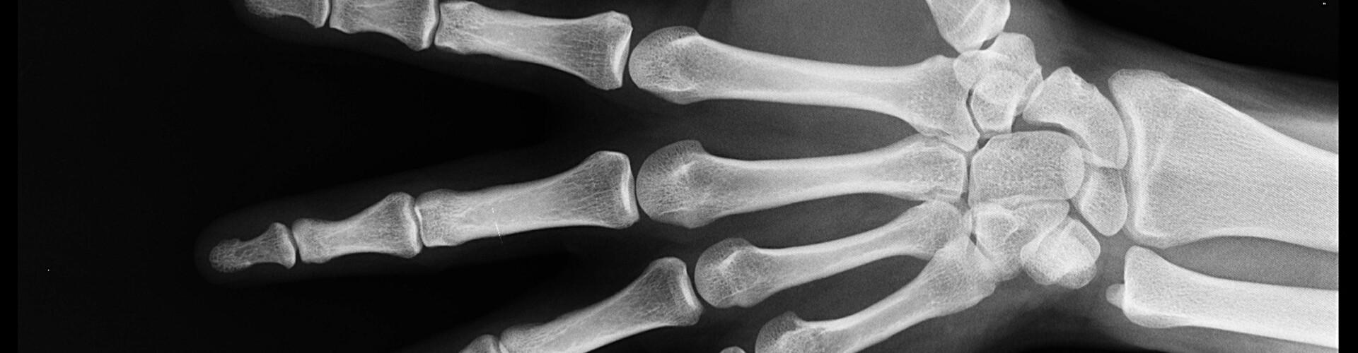 Osteoporose, botontkalking,  osteoporosis, bone loss