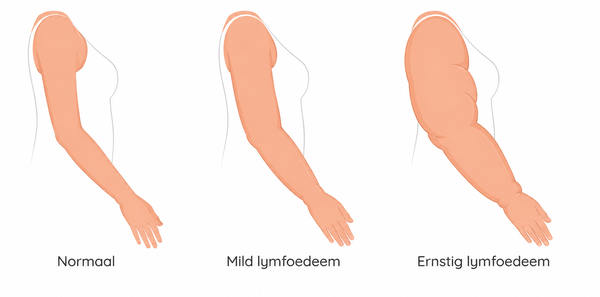 Voorbeeld van lymfoedeem in arm, onderarm en hand
