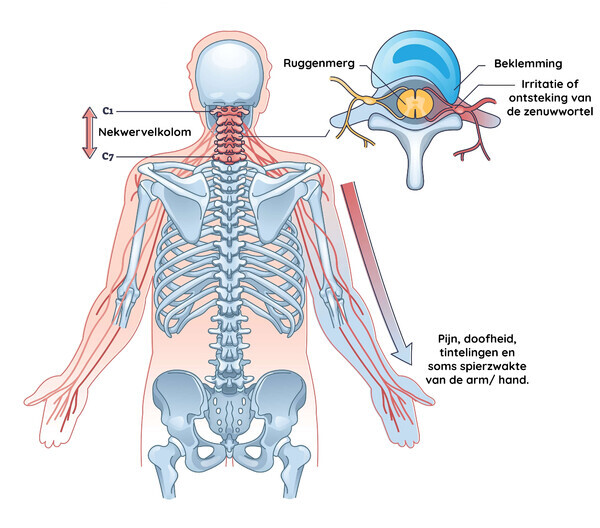 Nekhernia startafbeelding
